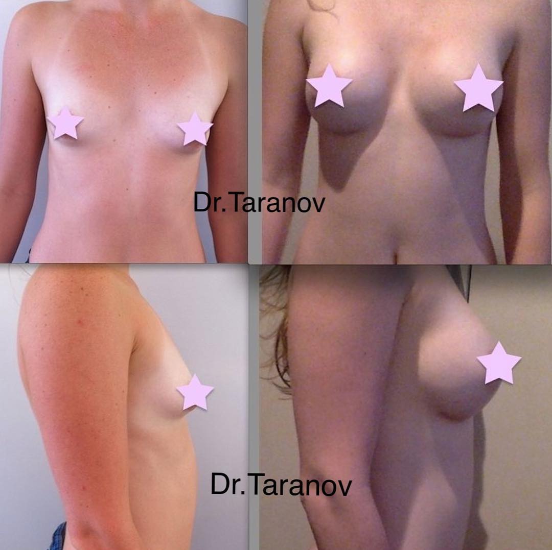 Увеличение груди, круглые имланты mentor, объём 350сс, доступ вокруг ареолы, 2 месяца после операции.