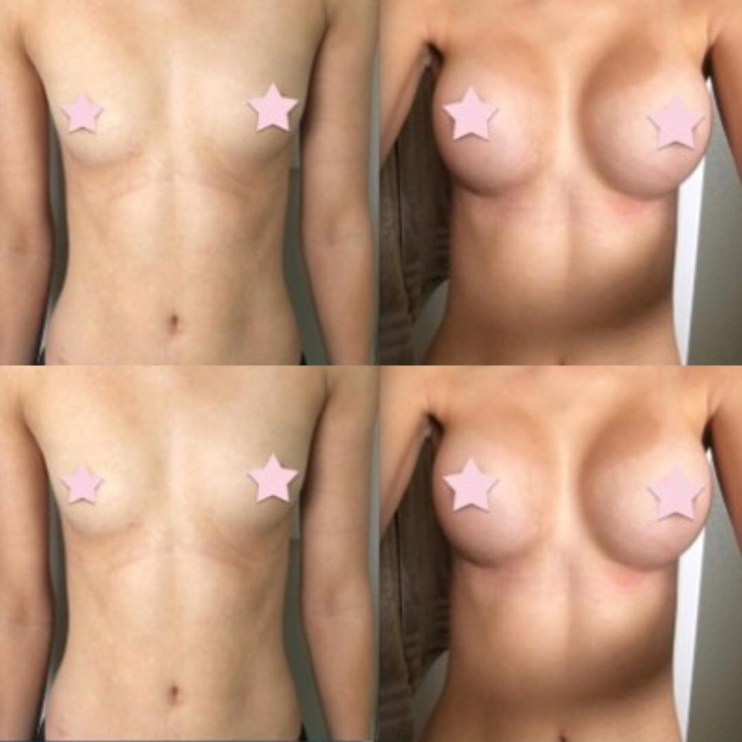 Увеличение груди, круглые имланты mentor, объём 350сс, доступ вокруг ореолы, 2 месяца после операции.